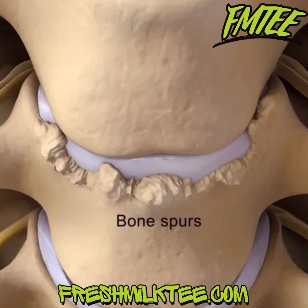 how to dissolve bone spurs naturally